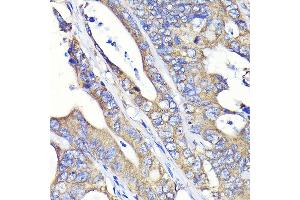 Immunohistochemistry of paraffin-embedded human colon carcinoma using Fatty Acid Synthase (FASN) Rabbit mAb  at dilution of 1:100 (40x lens).