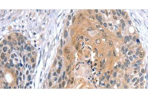 Immunohistochemistry of paraffin-embedded Human esophagus cancer using GNAT3 Polyclonal Antibody at dilution of 1:35 (GNAT3 anticorps)