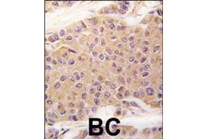 Formalin-fixed and paraffin-embedded human breast carcinoma tissue reacted with TGFB2 antibody , which was peroxidase-conjugated to the secondary antibody, followed by DAB staining. (TGFB2 anticorps  (C-Term))