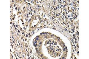 Immunohistochemistry of paraffin-embedded Human gastric cancer using ARRB2 Polyclonal Antibody at dilution of 1:200 (40x lens). (Arrestin 3 anticorps)