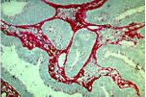 Human rectal carcinoma (MAb DB7, tenascin)