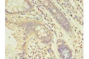 Immunohistochemistry of paraffin-embedded human colon cancer using ABIN7143952 at dilution of 1:100 (ABHD14A anticorps  (AA 56-258))