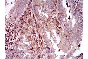 Immunohistochemical analysis of paraffin-embedded endometrial cancer tissues using MAPK14 mouse mAb with DAB staining.