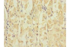 Immunohistochemistry of paraffin-embedded human gastric cancer using ABIN7153977 at dilution of 1:100