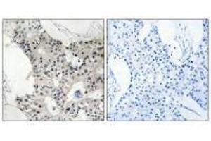 Immunohistochemistry analysis of paraffin-embedded human breast carcinoma tissue using BAGE4 antibody. (BAGE4 anticorps)