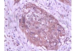 Formalin-fixed and paraffin embedded human cervical tissue labeled with Anti-STAT3 Polyclonal Antibody (ABIN738261), Unconjugated at 1:200 followed by conjugation to the secondary antibody, (SP-0023), and DAB staining