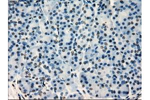 Immunohistochemical staining of paraffin-embedded Adenocarcinoma of colon tissue using anti-SATB1mouse monoclonal antibody. (SATB1 anticorps)