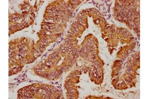 IHC image of ABIN7150537 diluted at 1:100 and staining in paraffin-embedded human endometrial cancer performed on a Leica BondTM system.