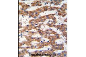 Formalin-fixed and paraffin-embedded human hepatocarcinoma tissue reacted with PHB antibody , which was peroxidase-conjugated to the secondary antibody, followed by DAB staining. (Prohibitin anticorps  (AA 89-117))