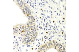 Immunohistochemistry of paraffin-embedded human metrocarcinoma using GEMIN2 antibody at dilution of 1:200 (400x lens). (SIP1 anticorps)