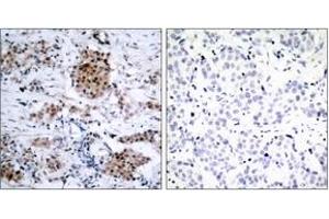 Immunohistochemistry analysis of paraffin-embedded human breast carcinoma, using Estrogen Receptor-alpha (Phospho-Ser167) Antibody.