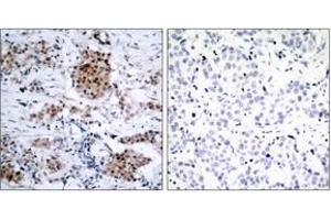 Immunohistochemistry analysis of paraffin-embedded human breast carcinoma, using Estrogen Receptor-alpha (Phospho-Ser167) Antibody. (Estrogen Receptor alpha anticorps  (pSer167))