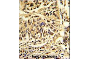 Formalin-fixed and paraffin-embedded human lung carcinoma reacted with CEBPB Antibody , which was peroxidase-conjugated to the secondary antibody, followed by DAB staining. (CEBPB anticorps  (C-Term))