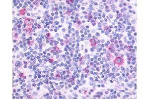 Anti-PTGIR / IP Receptor antibody IHC of human Lymph Node, Hodgkins Lymphoma.