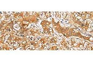 Immunohistochemistry of paraffin-embedded Human liver cancer tissue using RIDA Polyclonal Antibody at dilution of 1:65(x200) (HRSP12 anticorps)