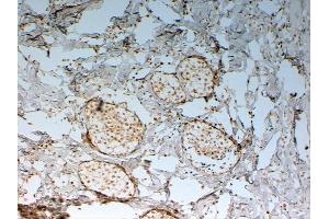ABIN185029 (2 µg/mL) staining of paraffin embedded Human Breast cancer.