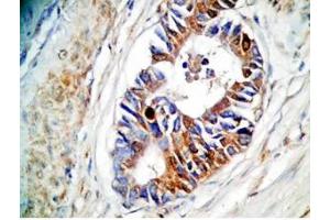 Human stomach cancer tissue was stained by rabbit Anti-Spexin prepro (73-116)  (H) Antiserum (Spexin anticorps  (Preproprotein))
