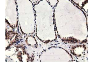 Immunohistochemical staining of paraffin-embedded Carcinoma of Human kidney tissue using anti-CBWD1 mouse monoclonal antibody. (CBWD1 anticorps)