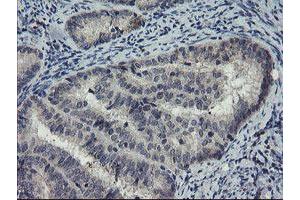 Immunohistochemical staining of paraffin-embedded Adenocarcinoma of Human endometrium tissue using anti-DOK7 mouse monoclonal antibody. (DOK7 anticorps)