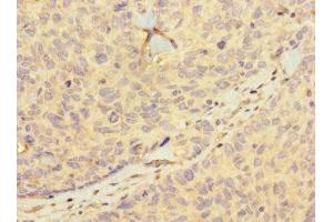 Immunohistochemistry of paraffin-embedded human ovarian cancer using ABIN7155399 at dilution of 1:100 (HIST1H2BD anticorps  (AA 2-57))