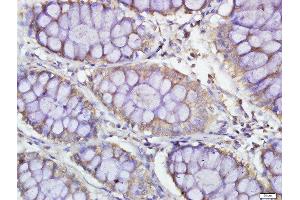 Paraformaldehyde-fixed, paraffin embedded human colon carcinoma, Antigen retrieval by boiling in sodium citrate buffer (pH6.