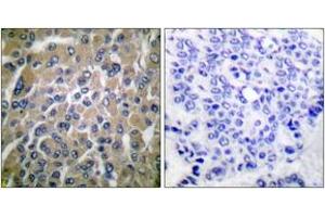 Immunohistochemistry analysis of paraffin-embedded human breast carcinoma tissue, using hCG beta Antibody. (HCG beta anticorps  (AA 101-150))