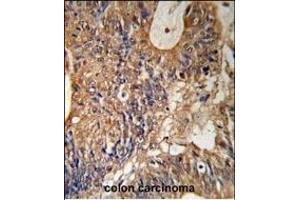 GSTP1 Antibody (Center) (R) IHC analysis in formalin fixed and paraffin embedded human colon carcinoma followed by peroxidase conjugation of the secondary antibody and DAB staining.