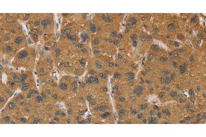 Immunohistochemistry of paraffin-embedded Human liver cancer tissue using CYP17A1 Polyclonal Antibody at dilution 1:30 (CYP17A1 anticorps)