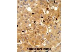 PRK Antibody (ABIN652306 and ABIN2841396) IHC analysis in formalin fixed and paraffin embedded human hepatocarcinoma followed by peroxidase conjugation of the secondary antibody and DAB staining. (PRKAA1 anticorps)