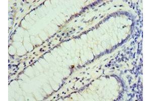 Immunohistochemistry of paraffin-embedded human colon cancer using ABIN7155860 at dilution of 1:100 (VENTX anticorps  (AA 1-258))