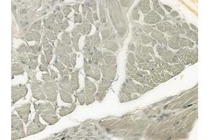 ABIN6261262 and ABIN6276488 at 1/100 staining human tongue carcinoma by IHC-P. (DEFB132 anticorps  (Internal Region))