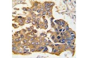 IHC analysis of FFPE human lung carcinoma tissue stained with Caspase-9 antibody