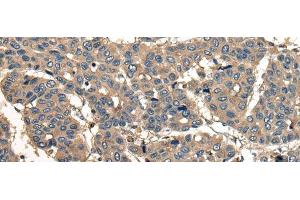 Immunohistochemistry of paraffin-embedded Human liver cancer tissue using CORO1B Polyclonal Antibody at dilution of 1:40(x200) (CORO1B anticorps)