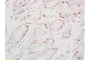 Formalin-fixed and paraffin embedded human gastric carcinoma labeled with Anti-TGF alpha Polyclonal Antibody, Unconjugated (ABIN724415) at 1:200 followed by conjugation to the secondary antibody and DAB staining (TGFA anticorps  (AA 40-89))