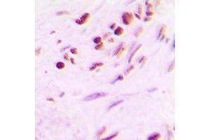 Immunohistochemical analysis of MYF5 staining in human lung cancer formalin fixed paraffin embedded tissue section.