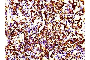 IHC image of ABIN7127297 diluted at 1:100 and staining in paraffin-embedded human lung cancer performed on a Leica BondTM system. (Recombinant HIST1H4A anticorps)