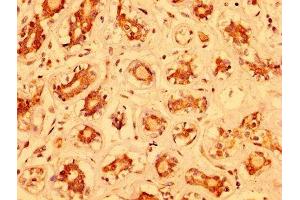 IHC image of ABIN7160478 diluted at 1:400 and staining in paraffin-embedded human breast cancer performed on a Leica BondTM system. (MZF1 anticorps  (AA 186-354))