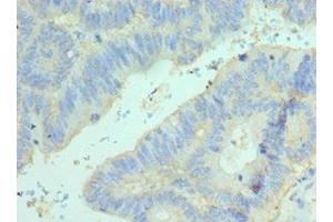 Immunohistochemistry of paraffin-embedded human colon cancer using ABIN7152098 at dilution of 1:100 (Elf4 anticorps  (AA 1-200))