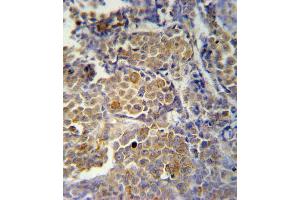 KIR2DS2 Antibody immunohistochemistry analysis in formalin fixed and paraffin embedded human skin carcinoma followed by peroxidase conjugation of the secondary antibody and DAB staining.