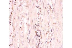 IHC-P: MRP4 antibody testing of human intestinal cancer tissue (ABCC4 anticorps  (AA 1-370))