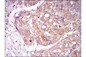 Immunohistochemical staining of human liver cancer tissues with TIE1 monoclonal antibody, clone 8D12B10  at 1:200-1:1000 dilution. (TIE1 anticorps  (AA 385-607))