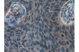 Detection of RXFP1 in Human Esophagus cancer Tissue using Polyclonal Antibody to Relaxin/Insulin Like Family Peptide Receptor 1 (RXFP1)