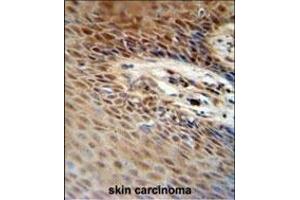 ZNF324B antibody (C-term) (ABIN654564 and ABIN2844270) immunohistochemistry analysis in formalin fixed and paraffin embedded human skin carcinoma followed by peroxidase conjugation of the secondary antibody and DAB staining. (ZNF324B anticorps  (C-Term))
