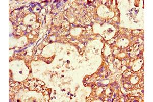 IHC-P analysis of Human Gastric cancer tissue, using AQP antibody (1/100 dilution). (AQP3 anticorps  (AA 210-244))