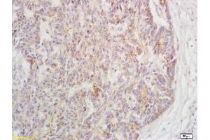 Formalin-fixed and paraffin embedded human rectal carcinoma labeled with Rabbit Anti-Phospho-TAK1(Ser192) Polyclonal Antibody, Unconjugated (ABIN802023) at 1:200 followed by conjugation to the secondary antibody and DAB staining (TR4 anticorps  (pSer192))