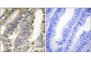Immunohistochemistry analysis of paraffin-embedded human colon carcinoma tissue, using TNFA Antibody. (TNF alpha anticorps  (AA 141-190))