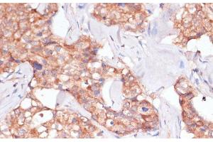 Immunohistochemistry of paraffin-embedded Human breast cancer using TIMM8B Polyclonal Antibody at dilution of 1:100 (40x lens). (TIMM8B anticorps)