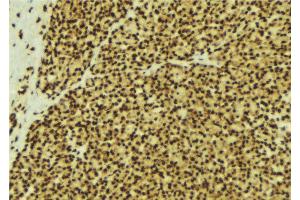 ABIN6269300 at 1/100 staining Human breast cancer tissue by IHC-P. (SMAD3 anticorps  (C-Term))