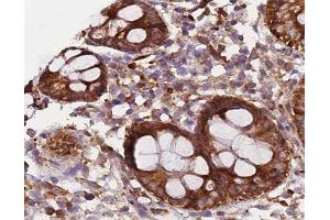 ABIN6266573 at 1/200 staining human colon carcinoma tissue sections by IHC-P.