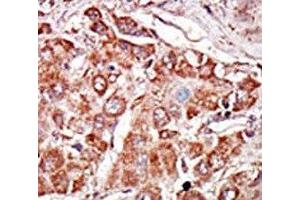 IHC analysis of FFPE human hepatocarcinoma stained with the PKR antibody (EIF2AK2 anticorps  (AA 11-42))